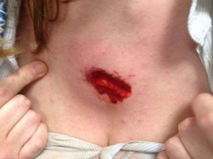 Effekt eines Hartgummigeschosses der Polizei auf der Brust einer Studentin
